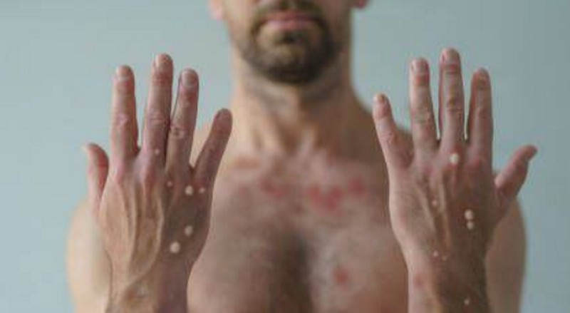 Viruela símica y herpes zóster: ¿cuáles son las diferencias? Viruela símica y herpes zóster: ¿cuáles son las diferencias?