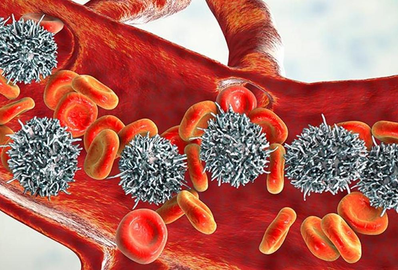 9 de cada 10 pacientes con leucemia linfocítica crónica no reconocen los síntomas antes del diagnóstico 9 de cada 10 pacientes con leucemia linfocítica crónica no reconocen los síntomas antes del diagnóstico